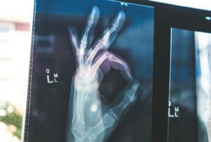 Hand X-ray showing detailed bone structure and joint positioning, relevant to frailty and ethnicity studies in medical imaging.
